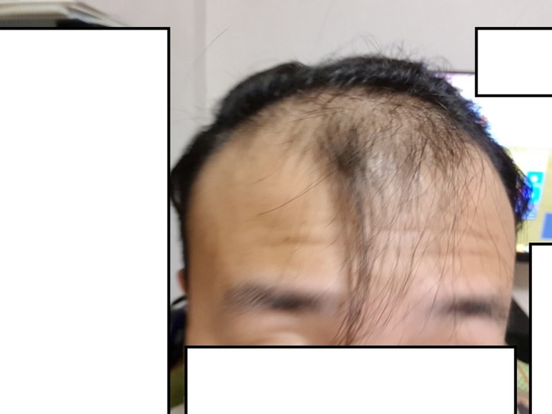모바른에서 수술한지 열흘 지남 (사진 저퀄)