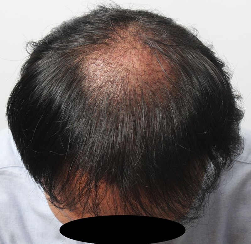 3주차 경과 정수리.JPG