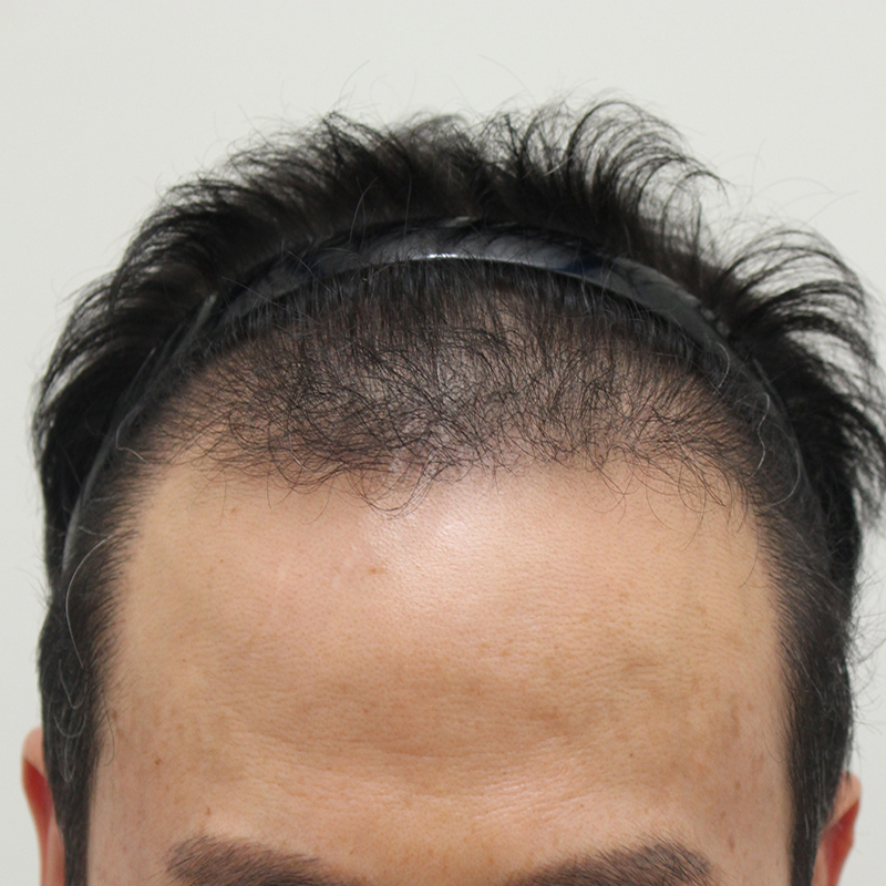 8.수술6개월째.jpg