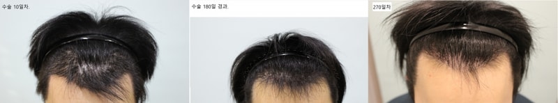 수술10일후.jpg