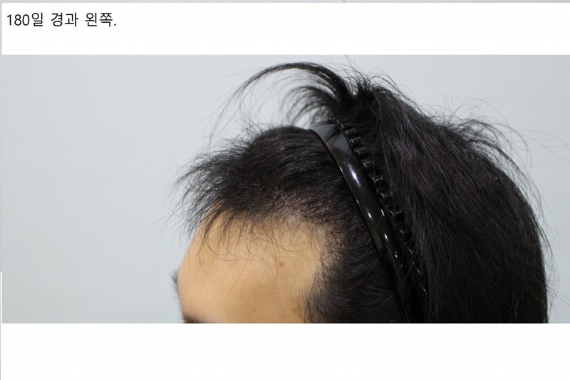 머리 왼쪽.jpg