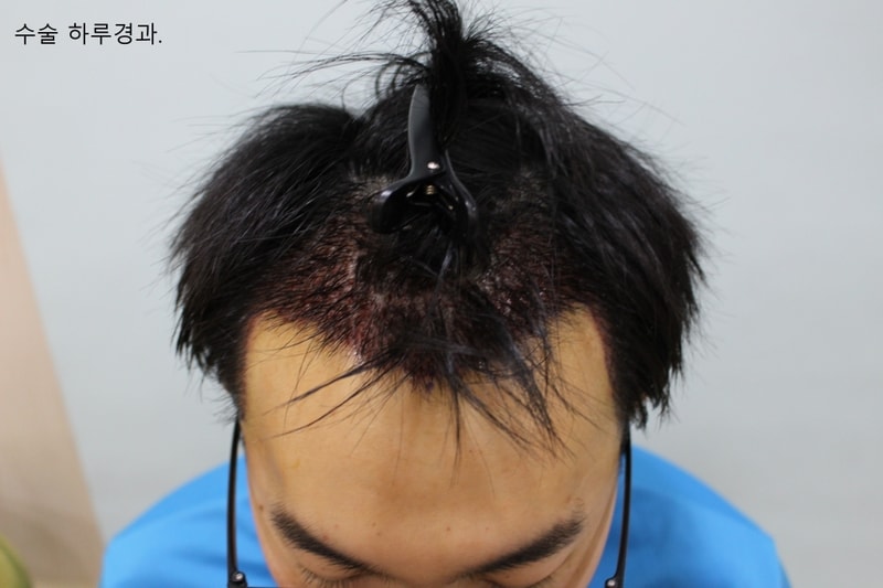 수술하루후.jpg