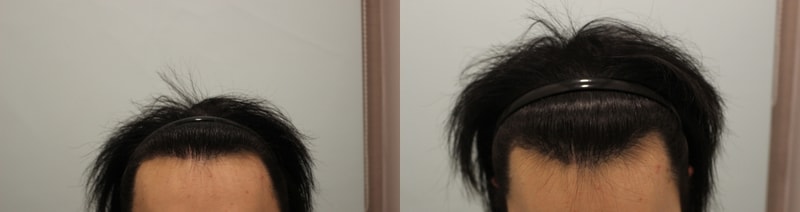 보강 10일차 낮은 용량.jpg