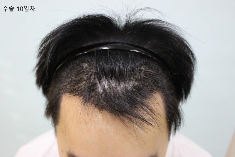 수술10일후.jpg