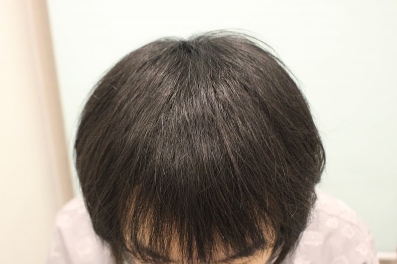 1년 경과 (5) 낮은 용량.jpg