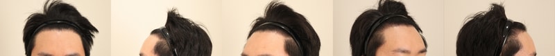 비절개 1년차 후기입니다