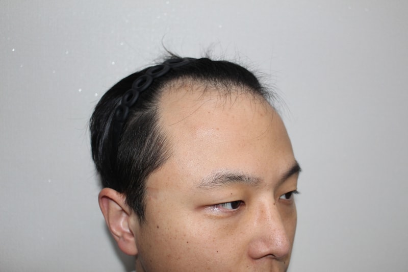 17-880907임상혁__수술전 (8).JPG