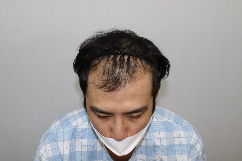 시술전.jpg