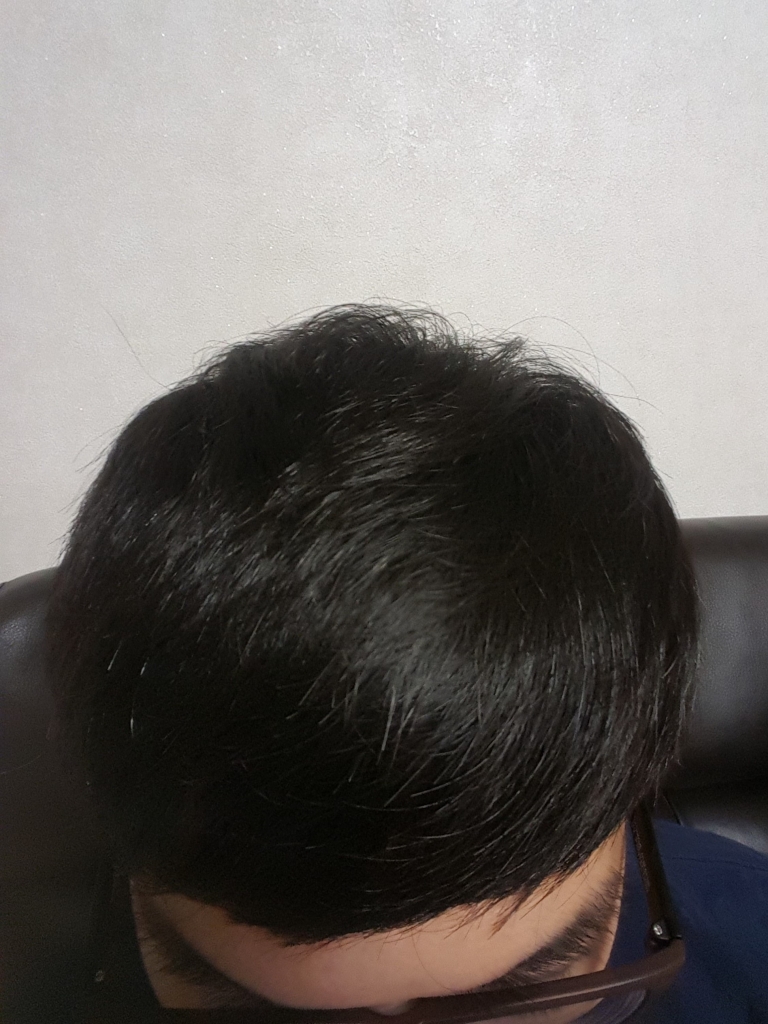 [1년2개월후기] 탈모 탈출 정상인으로 살기!!