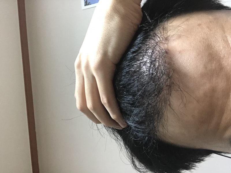 모바르한상보 비절개 2900모 139일차입니다