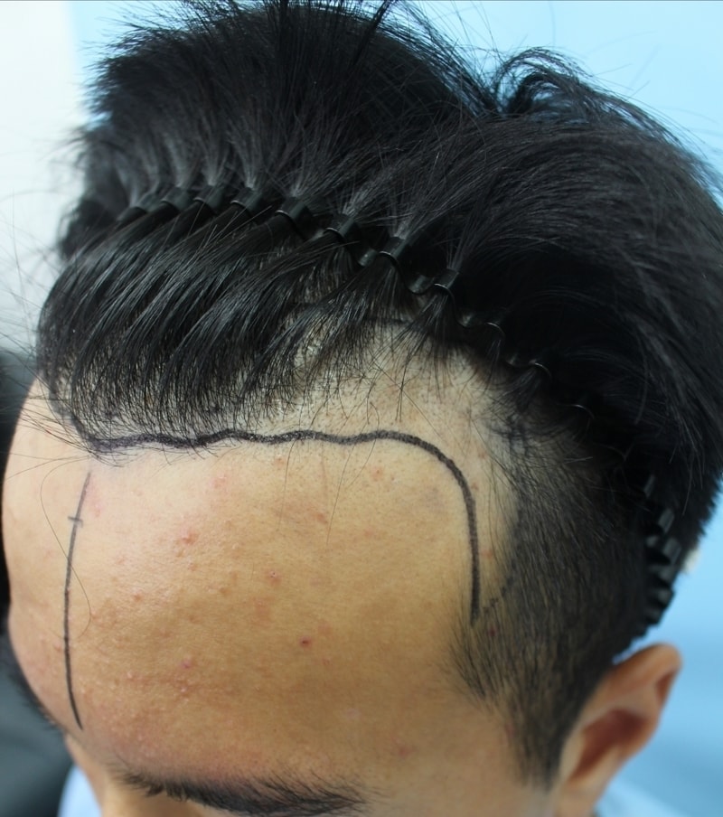 이식전 왼쪽.jpg