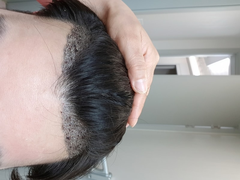 모발이식 일주일 경과 사진입니다!