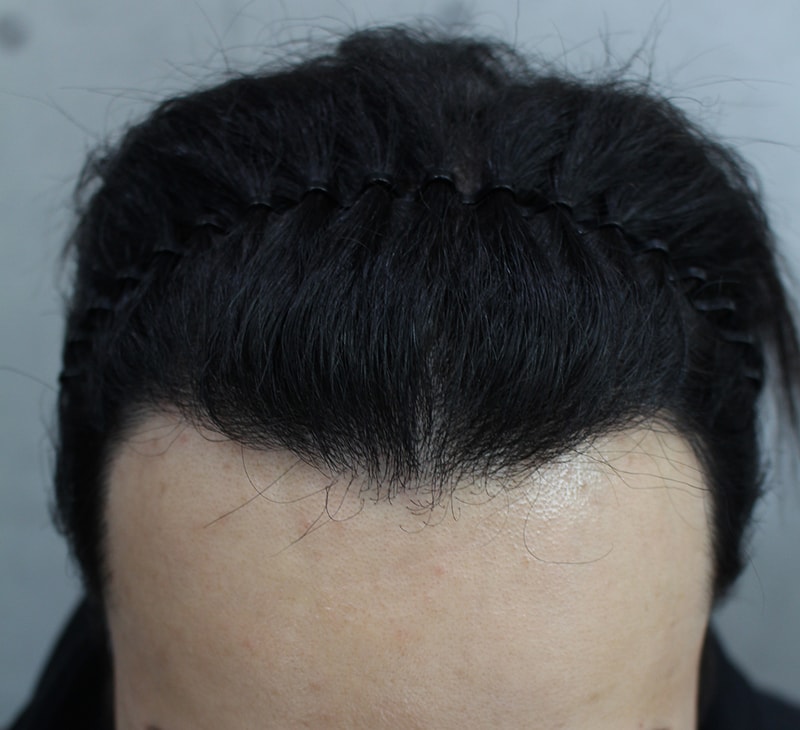 제대로 채워진 모발이식 1년 최종 졸업 사진 후기