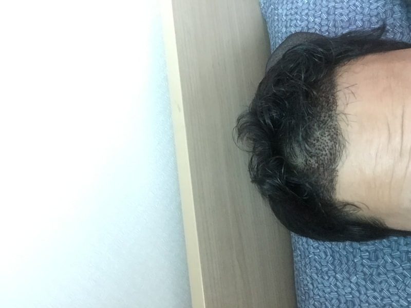 2주일이 지났습니다(비절개)