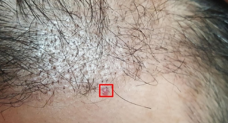 수술 100일차 맞아서 몇가지 느낀점을 공유합니다