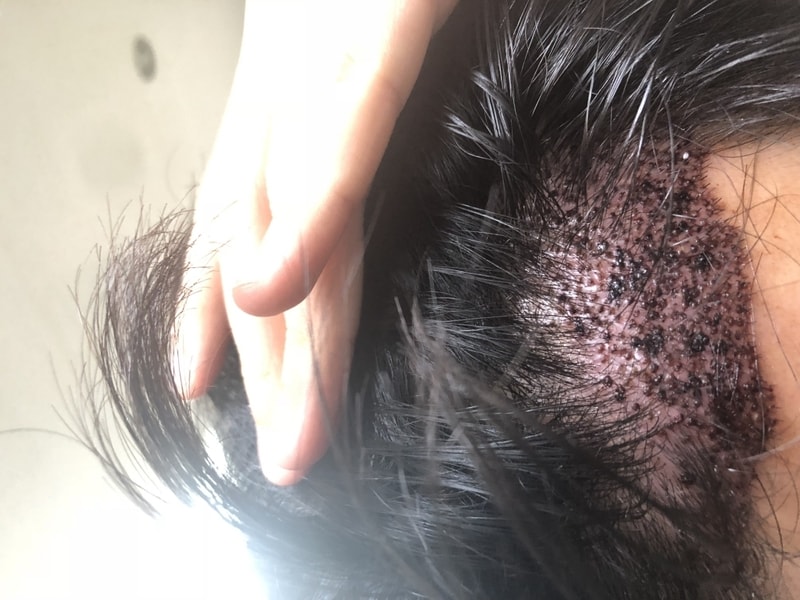 수술 밀도평가 부탁드립니다.