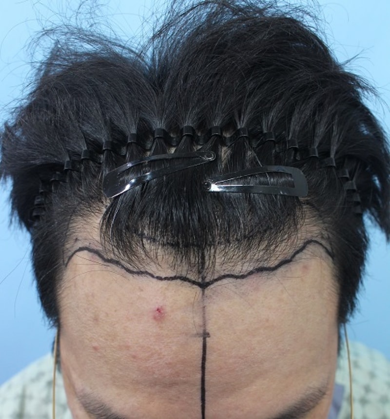 이마 수술전1.jpg