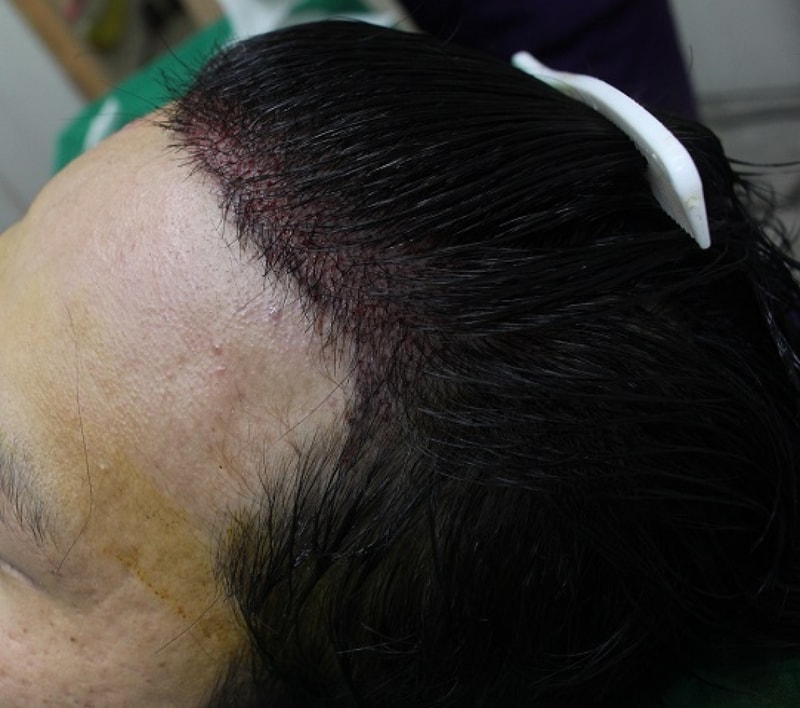 이마 수술후1.jpg