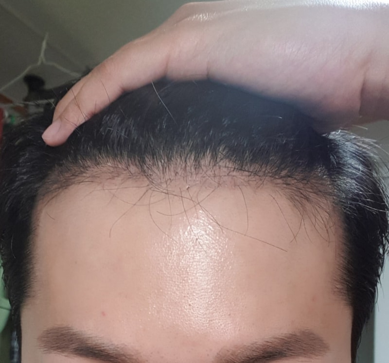 수술 86일 경과했네요.