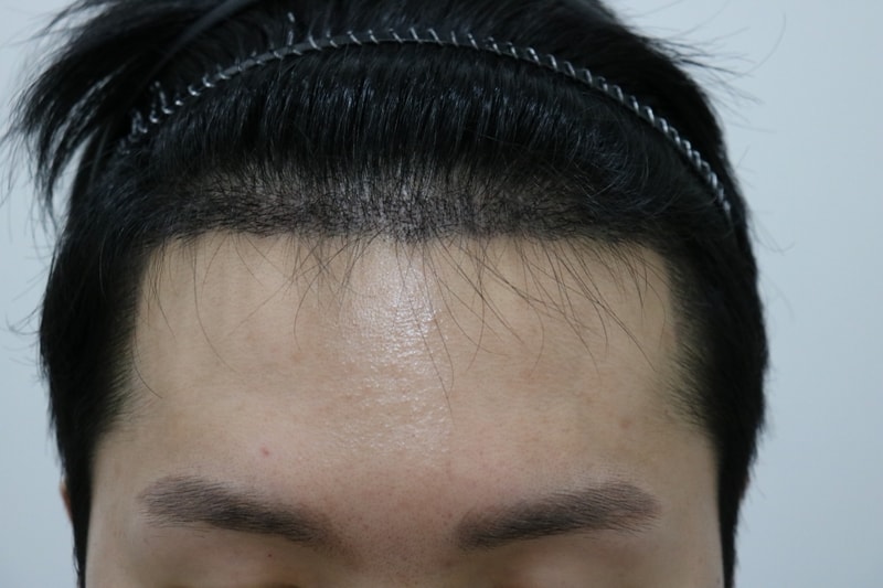 수술 2주차 생착기간 경과 관찰하러 다녀왔습니다!