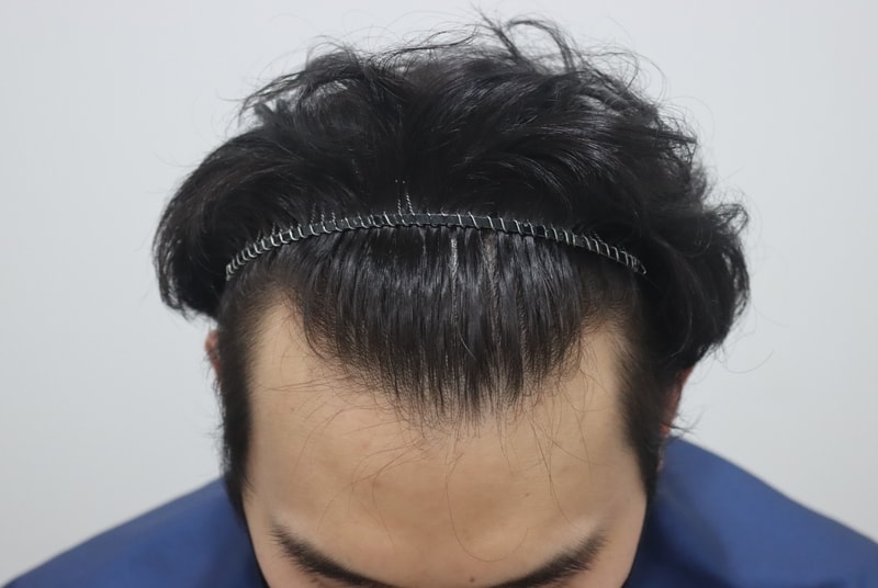 비절개 모발이식 후 2주 경과 후기 기록