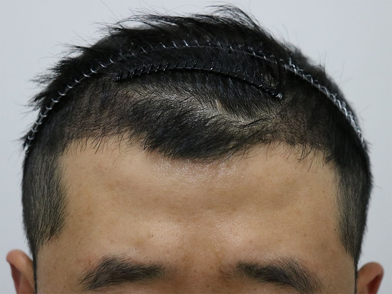 수술 후 1.jpg