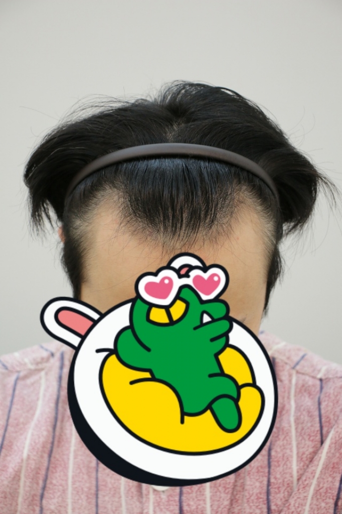 비절개 박스컷 1200모낭