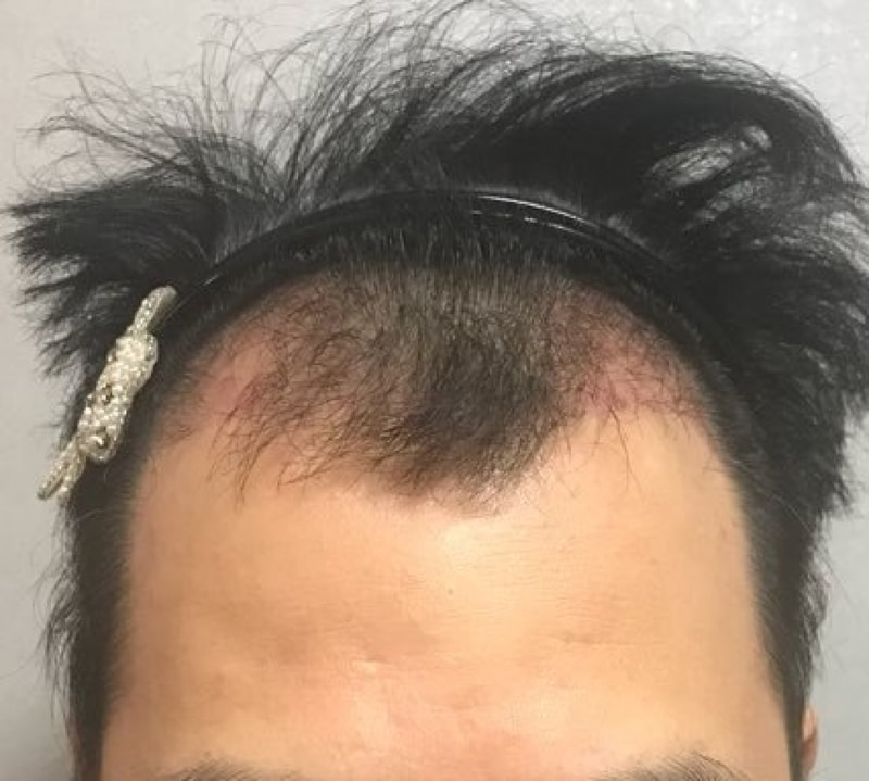 포헤어 비절개 2개월 돌입했는데 응원한마디씩만 부탁