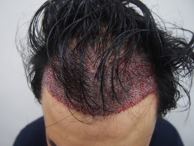 수술후1.JPG