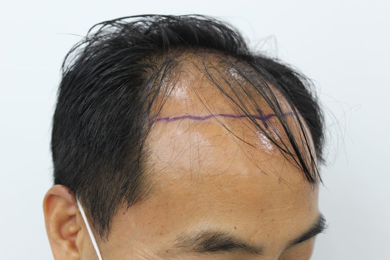 수술전 우.jpg