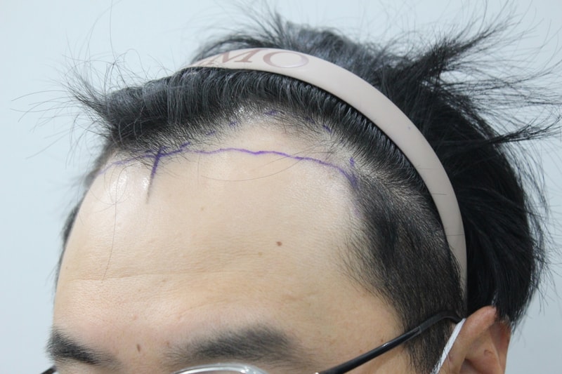 9수술전 옆모습 엠자가 옆에서도 보임.jpg