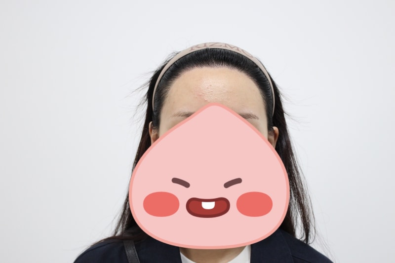 수술후 앞모습1년차 멀리서.jpg