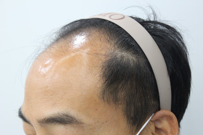 수술전 좌.jpg