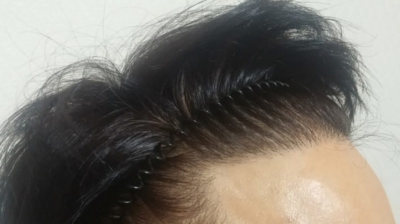 모재성비절개8개월차입니다