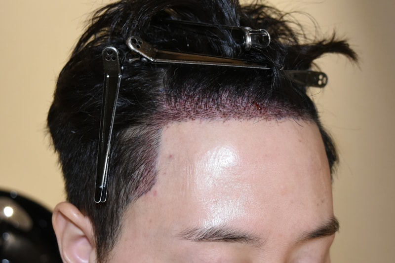 수술후측면1.jpeg