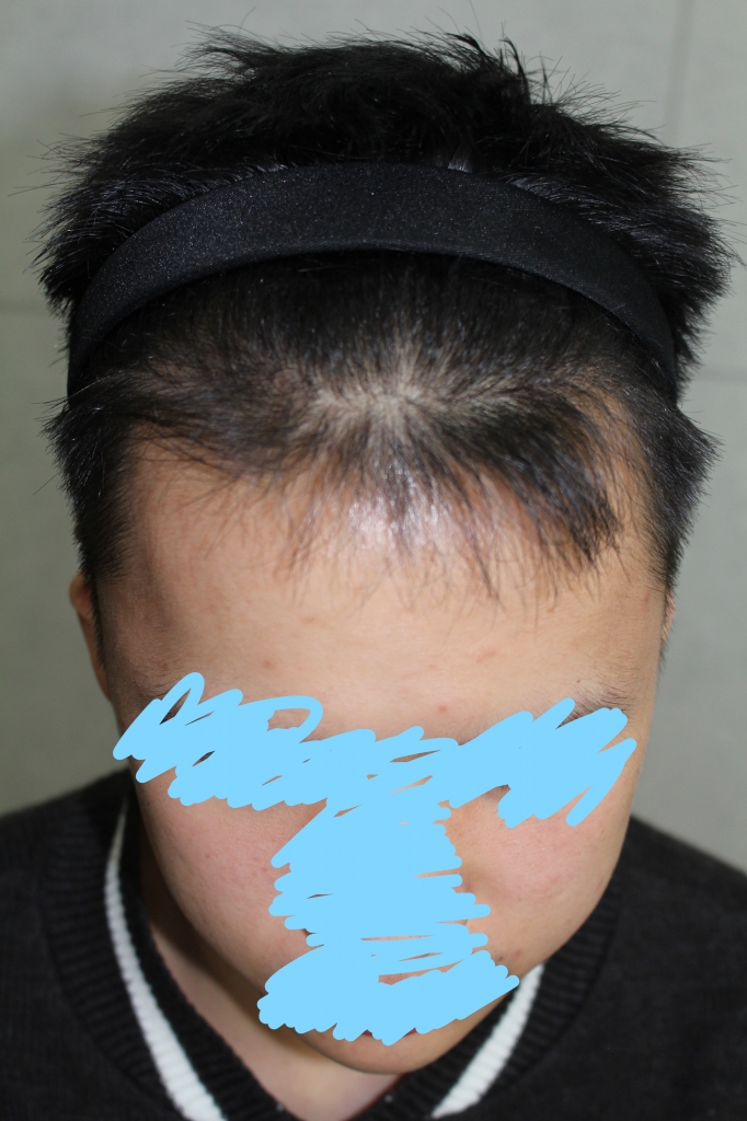 모발이식 후.jpg