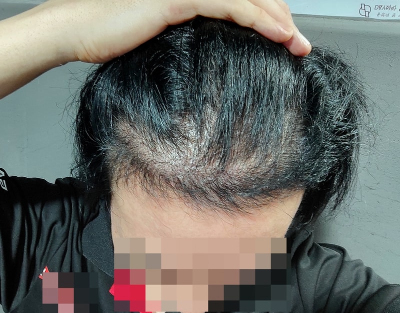 모발이식 3천모 비절개 5개월차 후기