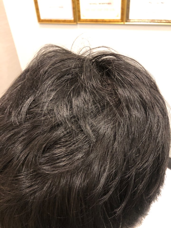 수술후1년 2.jpg