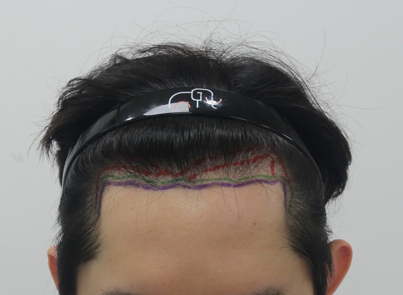 이마.JPG