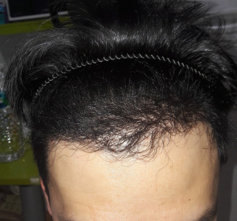 6개월차 경과사진올립니다.
