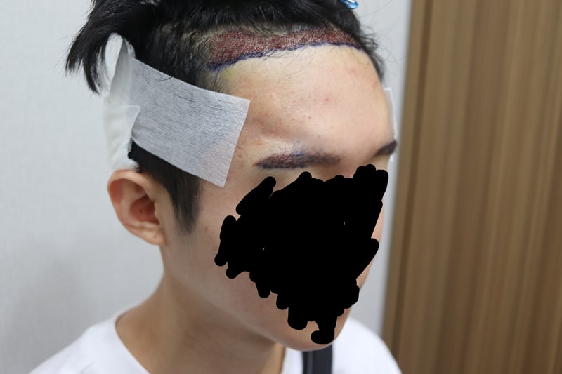 수술 후 옆면.jpg