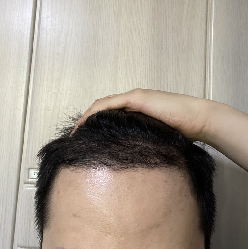 모발이식 약 4개월 경과입니다