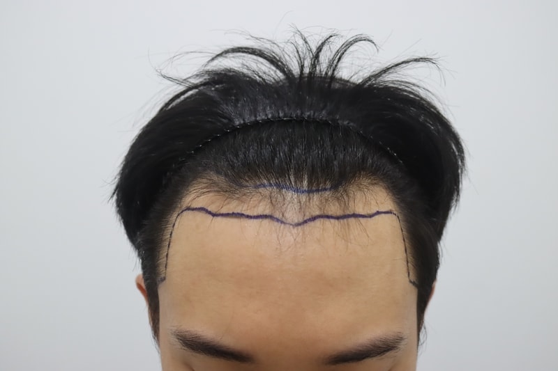 비절개 2800모 2개월차 후기