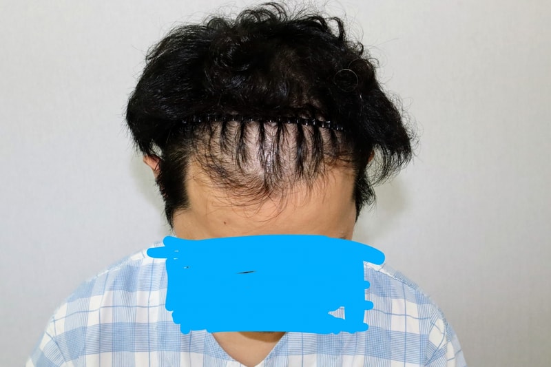 Late review 2 weeks after the Modi Hair Implant 3000 Mo implant.