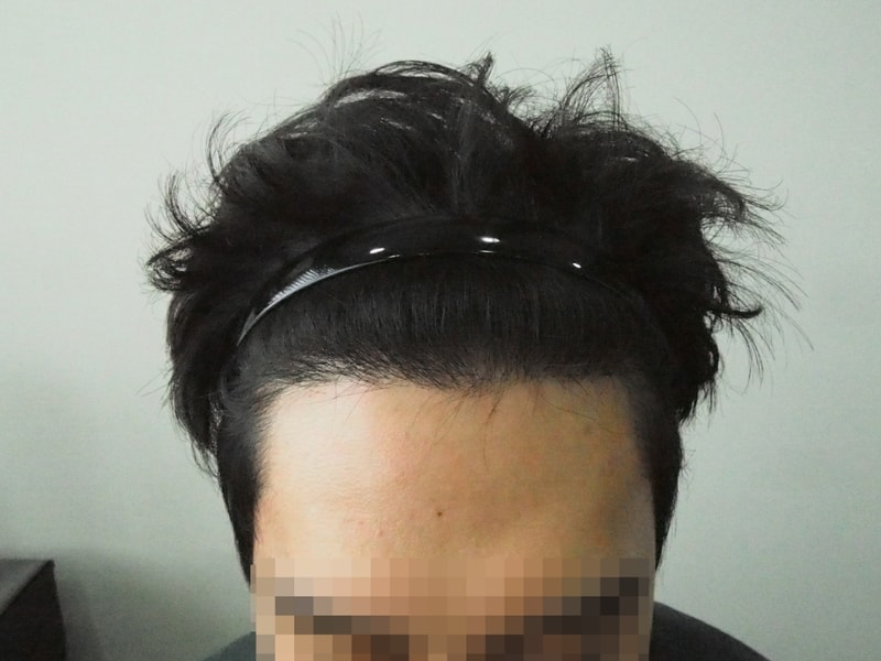 모재성 수술 4개월차 후기