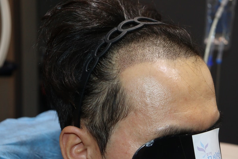 切開移植10日目体験談