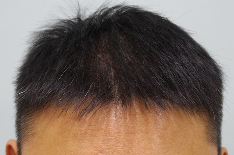 수술후 11일 (8).jpg
