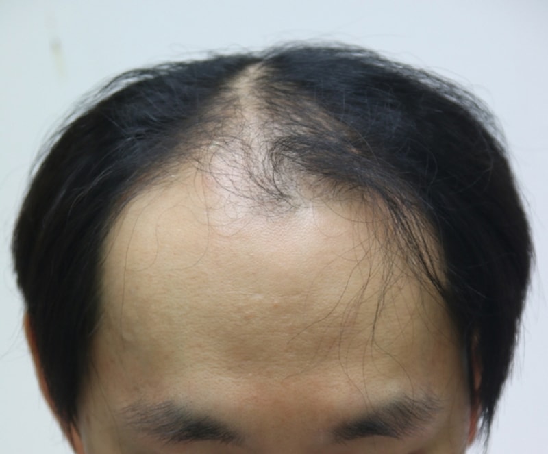 모발이식 2000모낭 3개월차