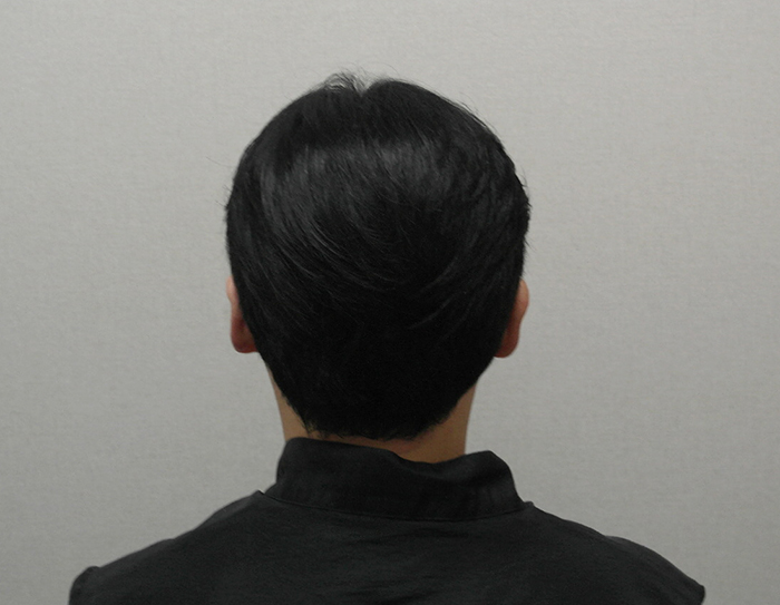 9- 수술다음날 뒷머리 사진입니다 무삭발로 수술해서 티가 1도 안나서 좋았어요 비용은 비쌌지만요 ㅠ 다음날 오후에 출근해야해서 어쩔 수 없이 무삭발로 진행.JPG