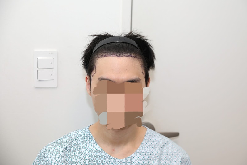 뉴헤어 모발이식 강남 1200모낭 1년차 후기